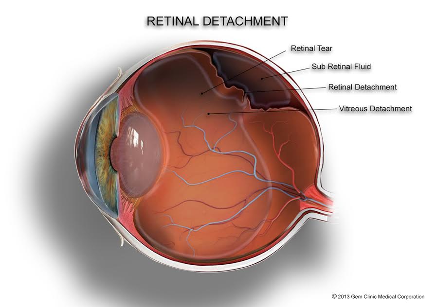Retinal Detachment Ophthalmologist